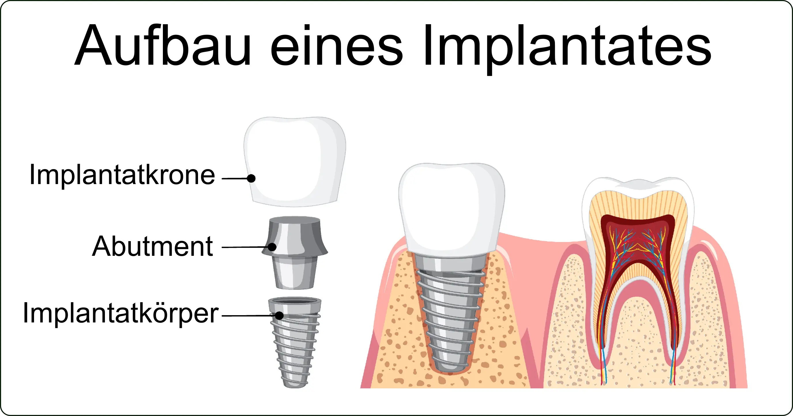 Bild - Aufbau eines Implantates