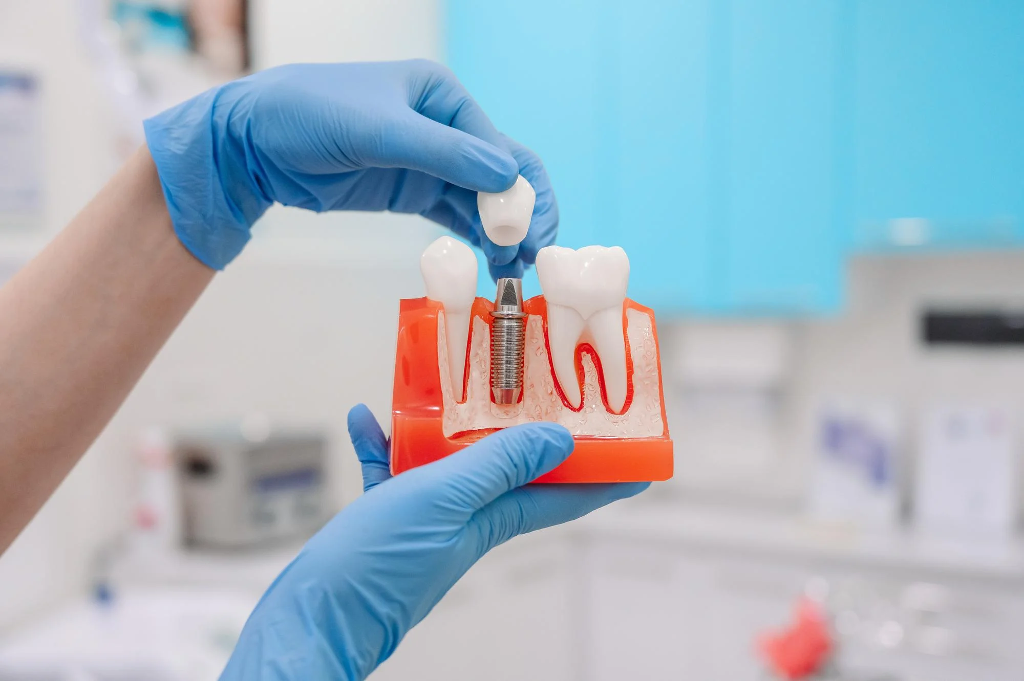 Anfertigung und Einsetzen der Krone